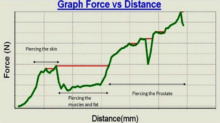 BrachyProstatewCatheterP_graph.png