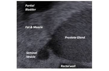 Ultrasound sagittal view of the prostate phantom