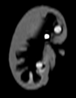 Kidney Phantom CT Image 2