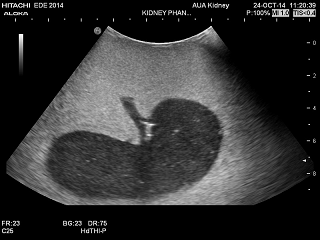 Kidney Phantom image png