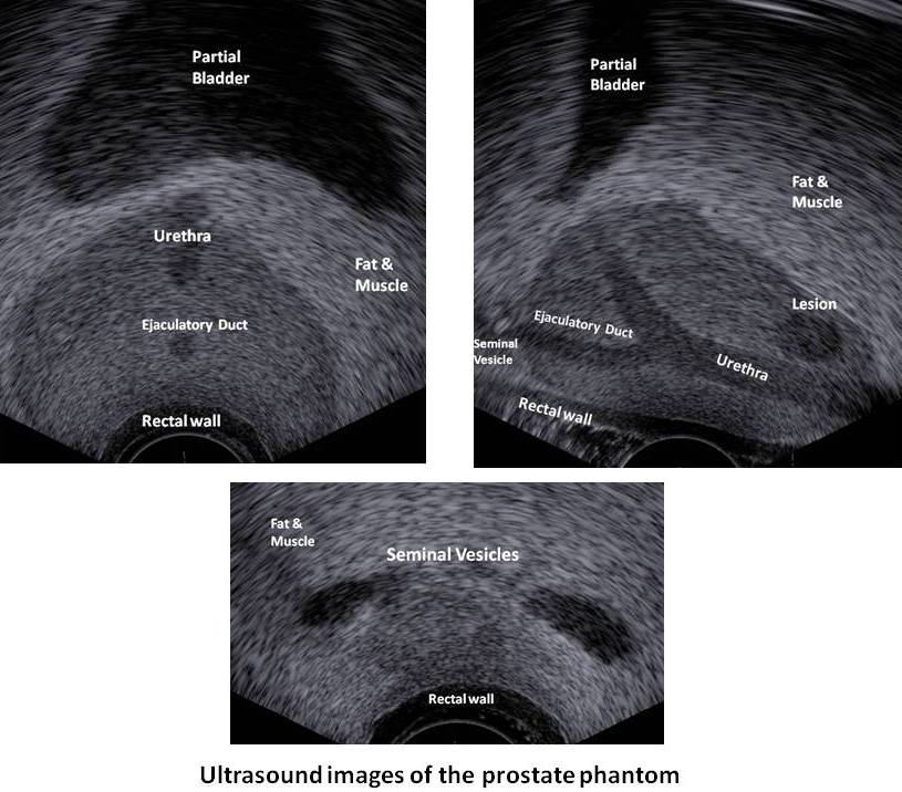 Ultrasound Images of the Prostate phantom image jpg